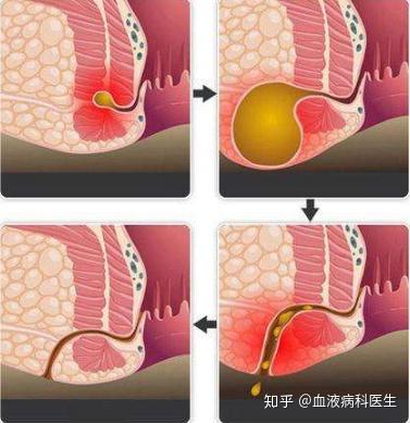 肛瘘啥系统,肛瘘——揭秘消化系统中的“排污系统”隐患