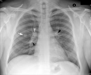 各系统肺瘤,肺瘤的类型