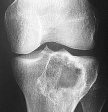 骨骼系统恶性最高的肿瘤,骨肉瘤——骨骼系统恶性程度最高的肿瘤