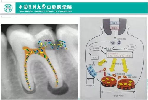 根管系统有,牙齿健康的守护者